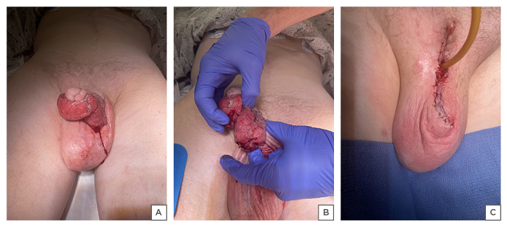 Figure 2 A B Circumferential penile mass before