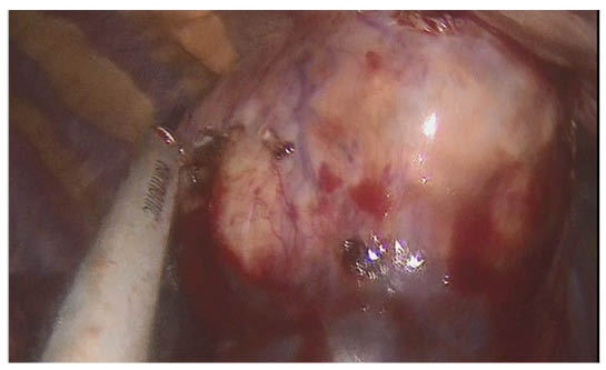Figure 2 Schwannoma during the minimally invasive surgery before converting it to an open thoracotomy