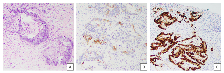 Figure 3 Interventional radiology liver biopsy consistent with