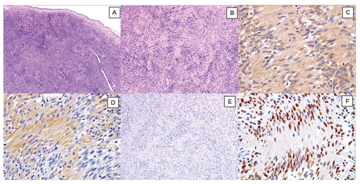 Figure 3 Microscopic appearance of haematoxylin and eosin stained resected tumour