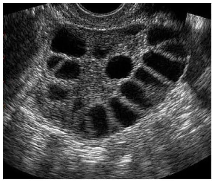 Normal Ovary Transvaginal Ultrasound