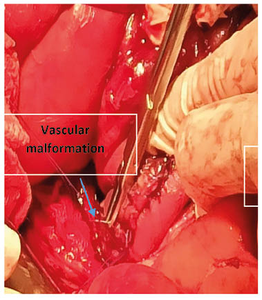 Figure 1 Location of the jejunal lesion.