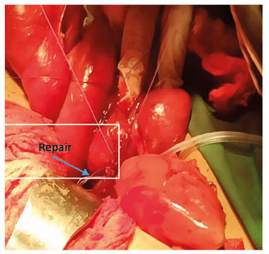 Figure 2 Resection anastomose.