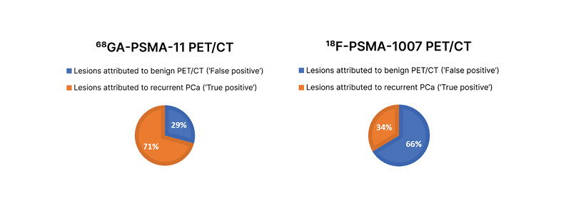 Figure 1 Distribution of suggestive and benign lesions for all PSMA-ligand–positive lesions on 68Ga-PSMA-11 PETCT and 1