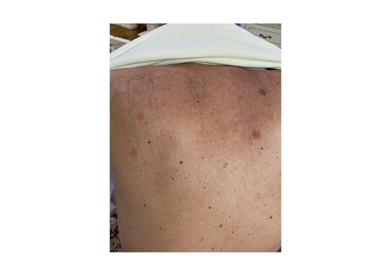 Figure 1 The positive patch testing (++) 96 hours after application (methyldibromo glutaronitrileon the left