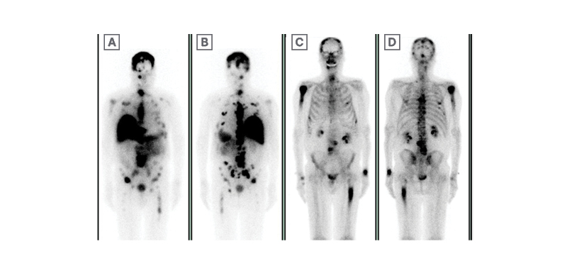Figure 3 Prostate-specific membrane antigen radiolabelling patient experience.