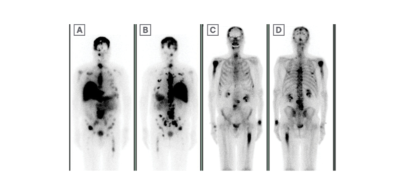 18F-fluciclovine-PET/CT imaging versus conventional imaging alone to guide  postprostatectomy salvage radiotherapy for prostate cancer (EMPIRE-1): a  single centre, open-label, phase 2/3 randomised controlled trial - The  Lancet