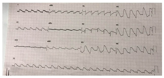 Figure 1 ECG during admission