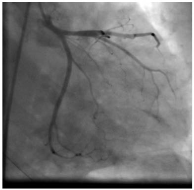 Figure 2 Normal angiogram of left anterior descending and left circumflex arteries during admission