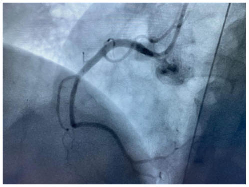Figure 3 Normal angiogram of right coronary artery during admission