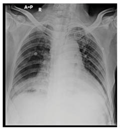 Figure 1 Chest X-ray showing right sided hilar lymphadenopathy