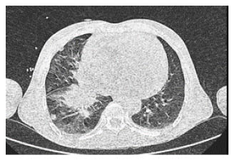 Figure 2 High resolution CT of the chest showing neoplastic right hilar lymphadenopathy and right lower lobe soft tissue and peri