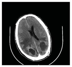 Figure 3 CT of the brain demonstrating well defined ring enhancing lesions in the parieto-occipital lobe with surrounding oedema