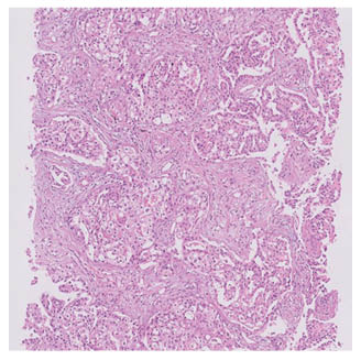 Figure 4 Lung biopsy showing adenocarcinoma
