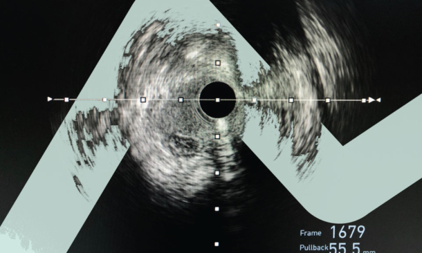 Intravascular ultrasound imaging (IVUS) shown guide wire in a false lumen during percutaneous coronary intervention (PCI) of chronic total occlusion (CTO) coronary artery