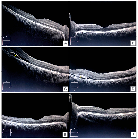 Figure 1 Optical coherence tomography images