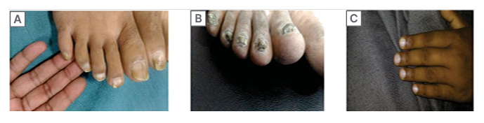 Figure 3 A) Lindsay’s half and half nails, a characteristic colored band over distal nail plate and pale proximal