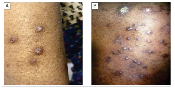 Figure 4 Perforating folliculitis with keratotic papules over leg (A) and abdomen (B). Note severe ichthyotic skin over the trunk