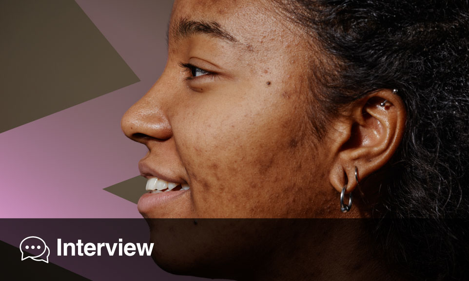 Acne Treatment Review and Present Perspectives