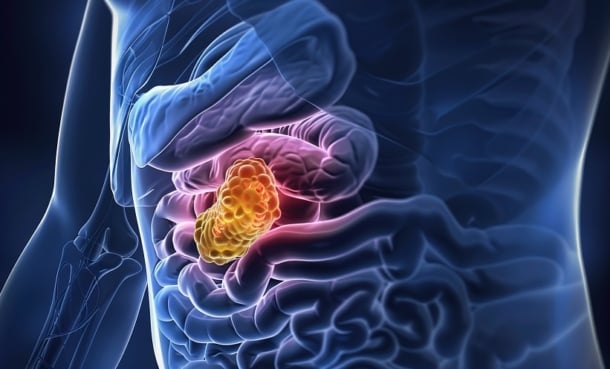 pancreatic cancer