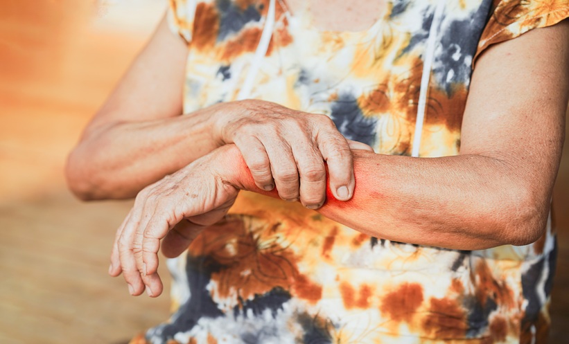 psoriatic arthritis
