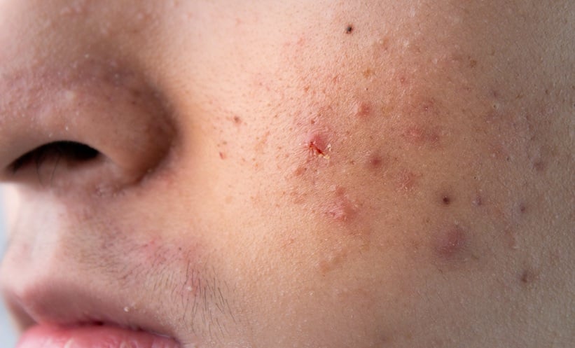 Acne Risk Rises Markedly After Gender-Affirming Hormone Therapy