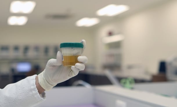 Urinary microRNAs Show Promise for Subtyping of Bladder Cancer