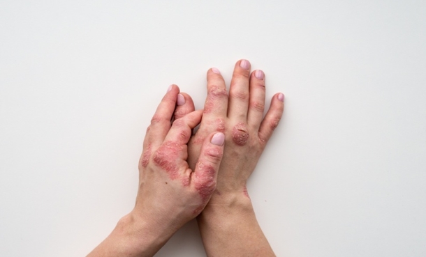 Risankizumab Shows Long-Term Psoriasis Benefits on OCT - EMJ