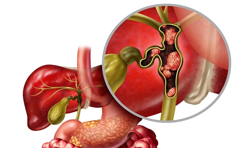 Molecular profiling improved survival in advanced cholangiocarcinoma - EMJ