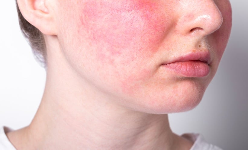 Diet, Oxidative Stress and Rosacea Severity - EMJ