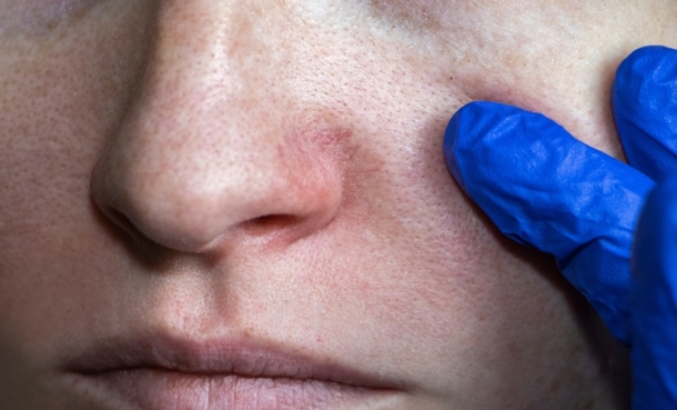 Clinician examining facial acne during dermatology visit