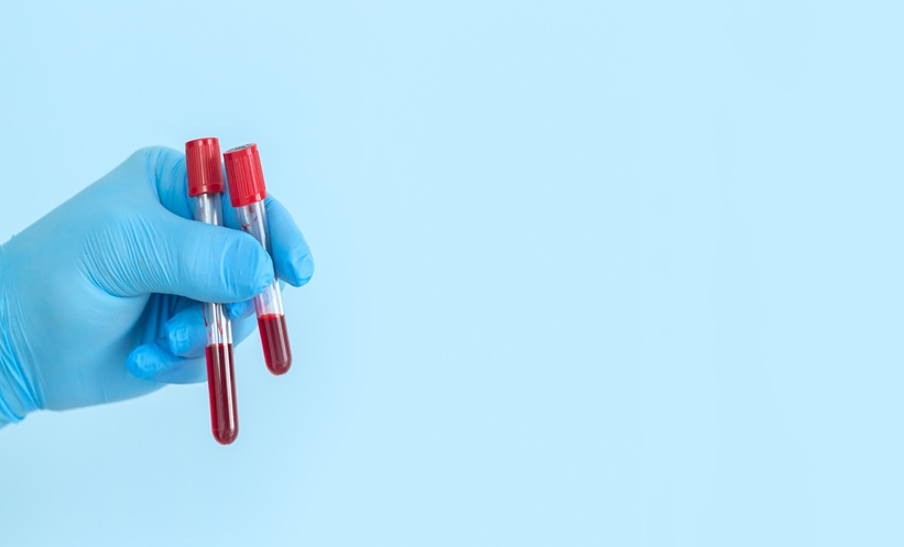 Red Blood Cell Immunization Linked to Reduced Survival in MDS