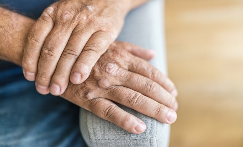 Vunakizumab Shows Efficacy in Psoriatic Arthritis - EMJ
