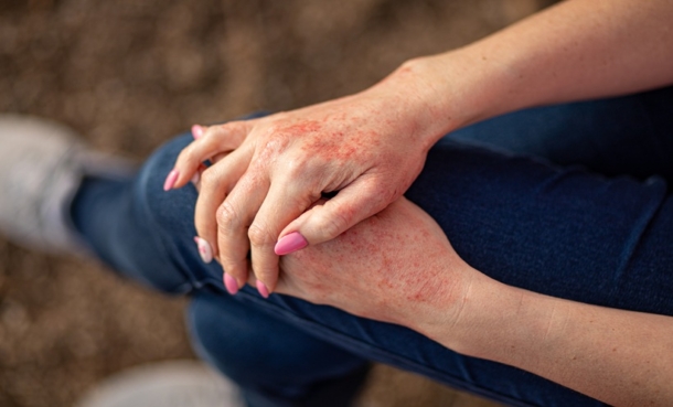 Topical Pumecitinib for Mild-to-Moderate Atopic Dermatitis - EMJ