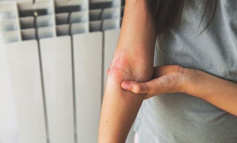 Minimal Disease Activity in Atopic Dermatitis - EMJ