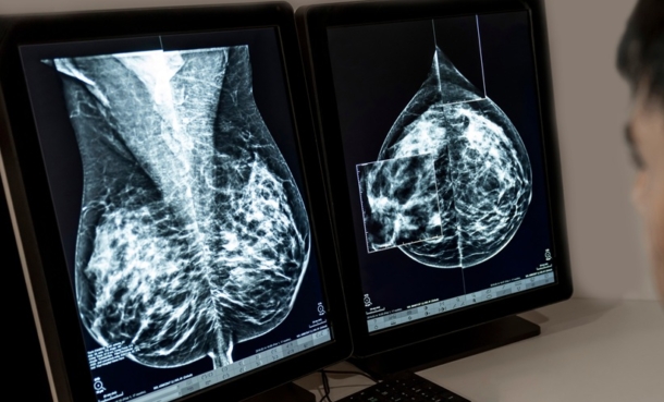 Effective Imaging Techniques in Survivors of Breast Cancer