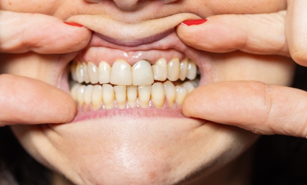 Severe gum disease and mild cognitive impairment risk in middle-aged adults