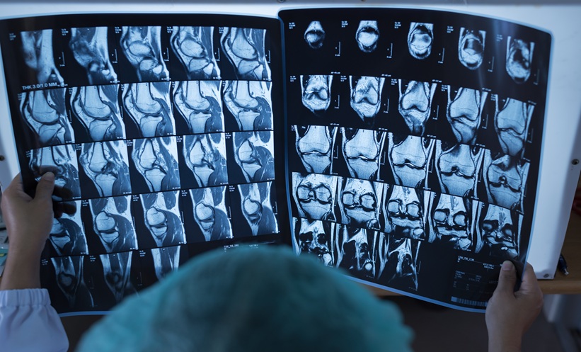 Knee MRI scans showing articular cartilage, illustrating advances in cartilage imaging techniques.