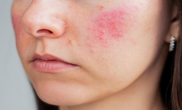 Rosacea and Depression Risk: New Cohort Evidence - EMJ