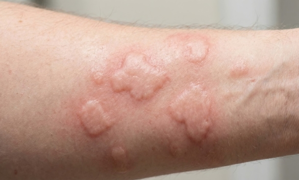 Chronic Spontaneous Urticaria