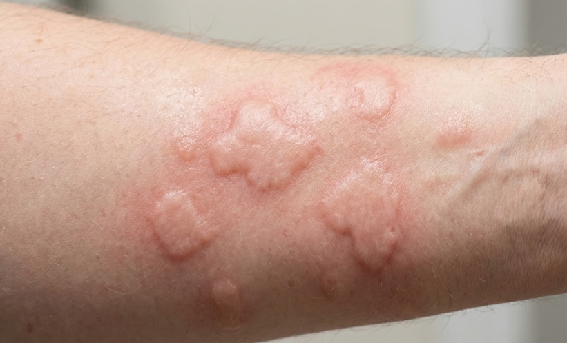 Chronic Spontaneous Urticaria