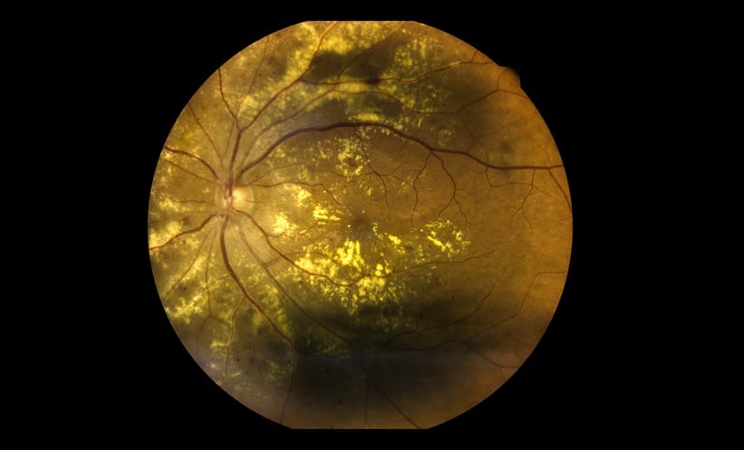 Metformin May Reduce Risk of Age-Related Macular Degeneration