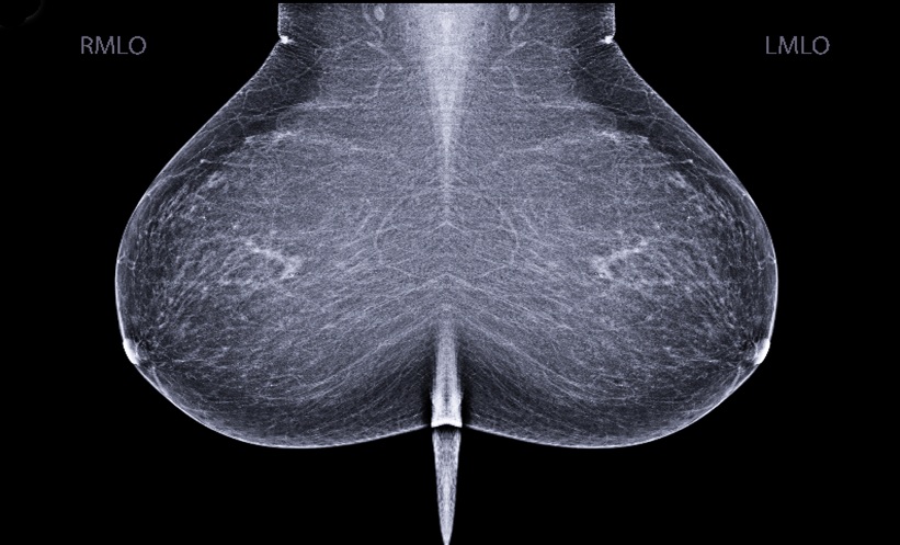 Patient Trust Drops with Discordant AI Mammography - EMJ