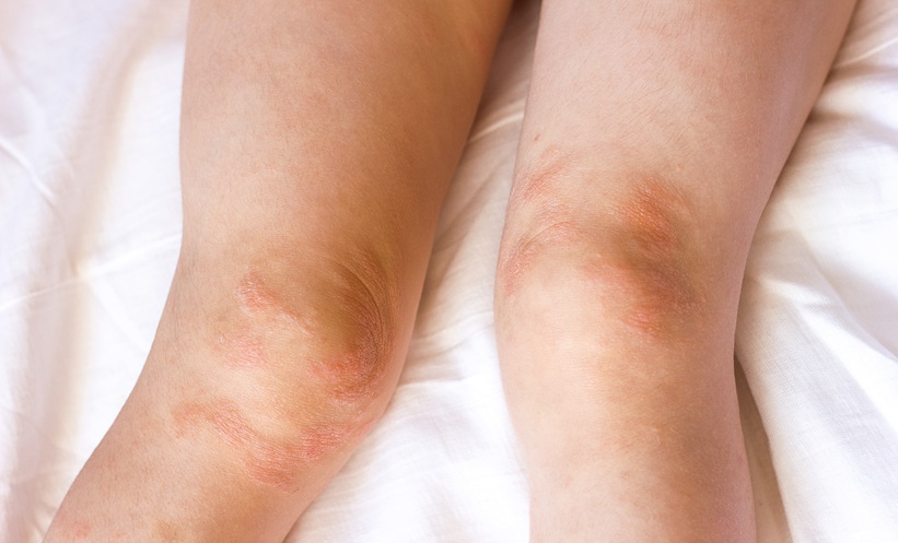 Visible atopic dermatitis rash on the knees of a pediatric patient
