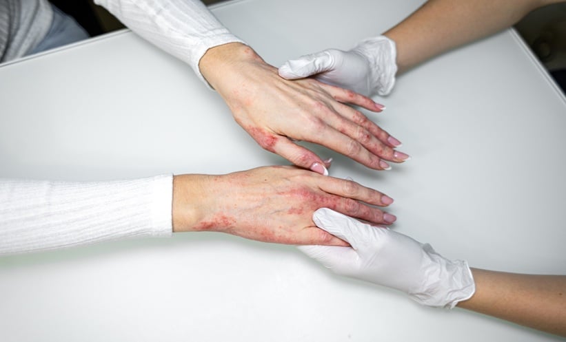 Treatment of eczema on hands with medical professional assisting in dermatology clinic