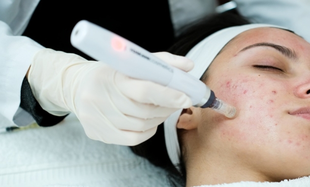 Patient receiving microneedling treatment on her cheek