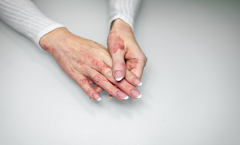 Hands affected by eczema showcasing redness and irritation after contact dermatitis in a neutral setting