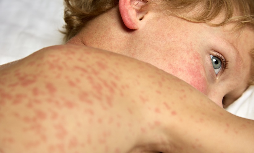 Measles Outbreak Drives Vaccine Push in London - EMJ