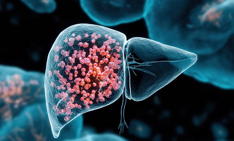 hepatocellular carcinoma