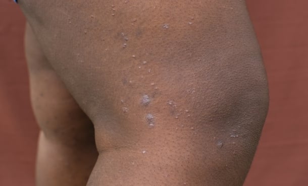 Dupilumab Improves Prurigo Nodularis Severity - EMJ